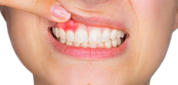 enfermedad-encias-gingivitis boca gingivitis