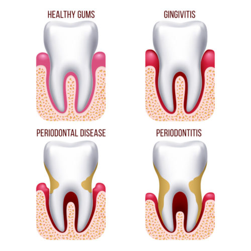 gingivitis - periodontitis