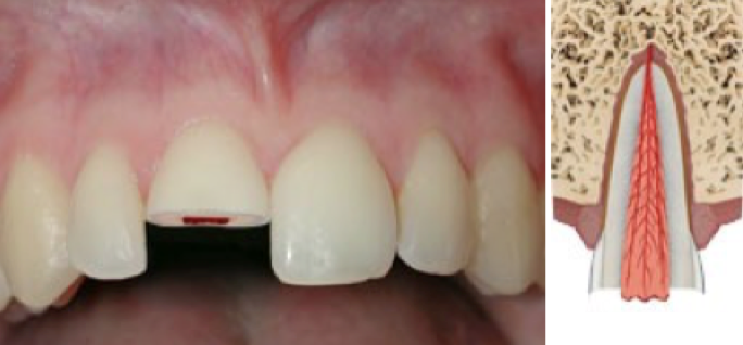 fractura-de-corona-dental-con-afectacion-pulpar
