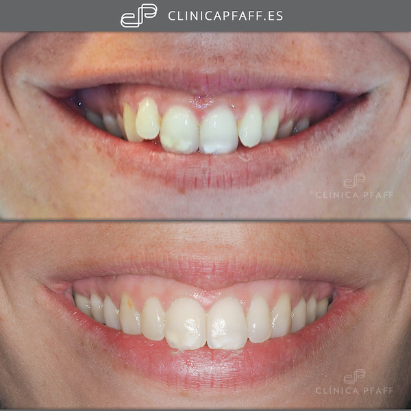 antes-y-despues-tratamiento-ortodoncia-brackets-barcelona-Pfaff-sant-gervasi-01 antes-y-despues-tratamiento-ortodoncia-brackets-barcelona-Pfaff-sant-gervasi-01