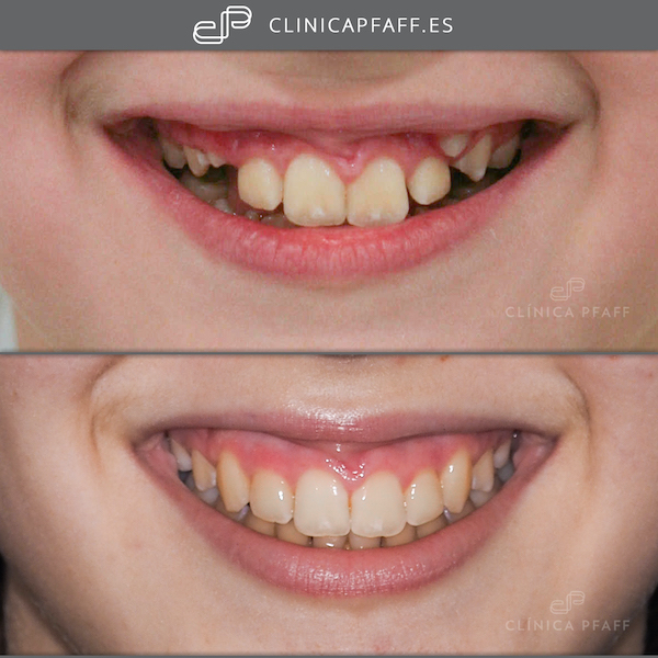 clinica-dental-tratamiento-ortodoncia-fija-brackets-barcelona-Pfaff-sant-gervasi-03