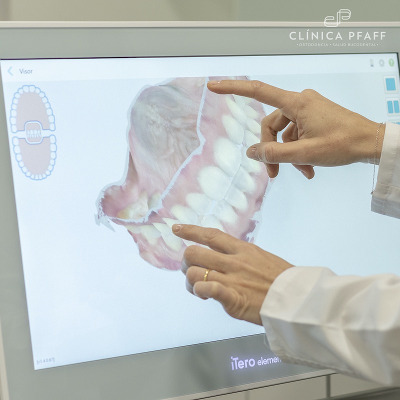 escaner-itero-tecnologia-para-ortodoncia-clinica-dental-pfaff-en-barcelona copia
