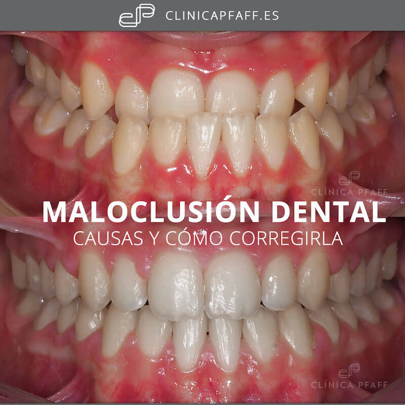 maloclusion-dental-causas-y-soluciones-pfaff