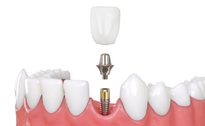 implantes-carga-inmediata-barcelona implantes-carga-inmediata-barcelona