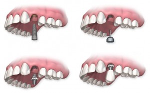 proceso-implante-dental-carga-inmediata-barcelona