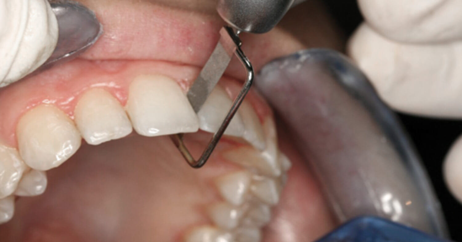 stripping-dental-ortodoncia-pfaff stripping-dental-ortodoncia-pfaff