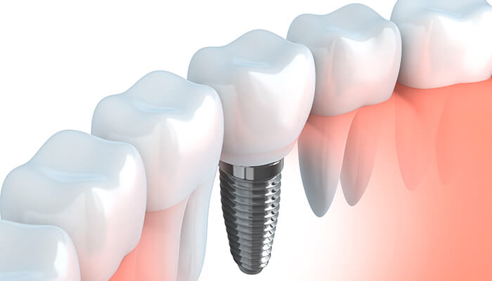 implante-dental-barcelona-clinica-pfaff