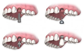 proceso-implantes-dentales