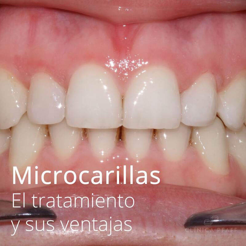 microcarillas-carillas-sin-tallado-barcelona-pfaff