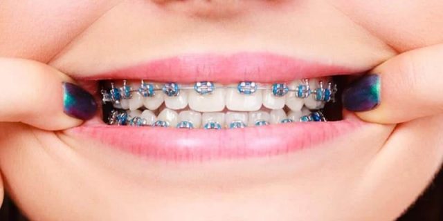 brackets-para-dientes-torcidos