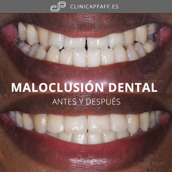 maloclusion-dental-antes-y-despues-clinica-barcelona
