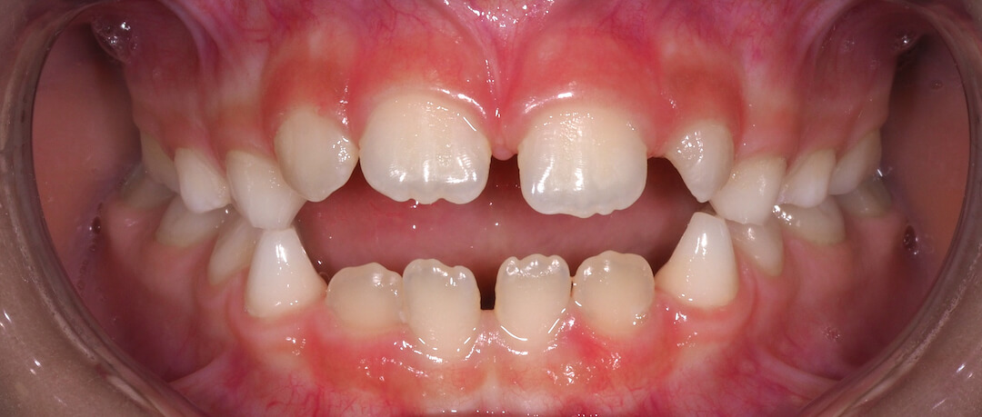 agenesia-dental-tratamiento-barcelona agenesia-dental-tratamiento-barcelona