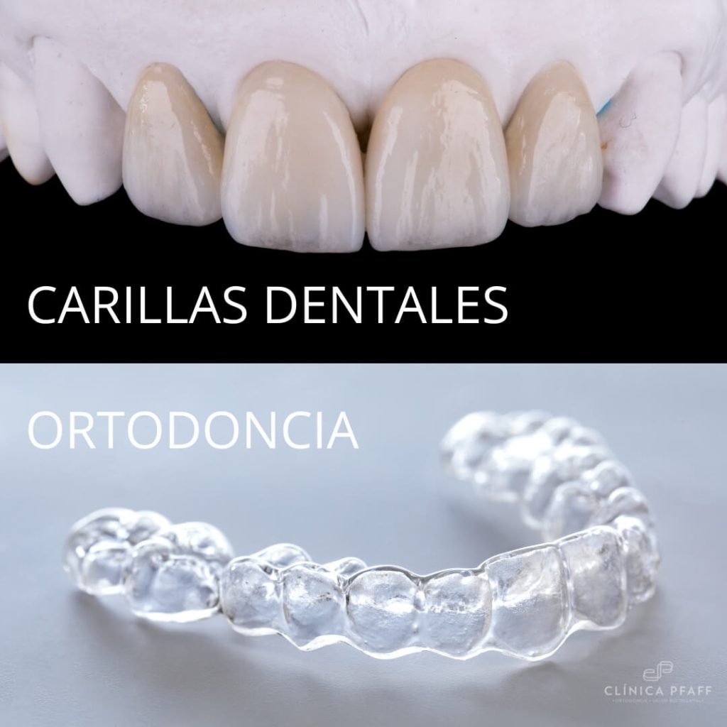 Comparación entre carillas dentales y alineadores de ortodoncia