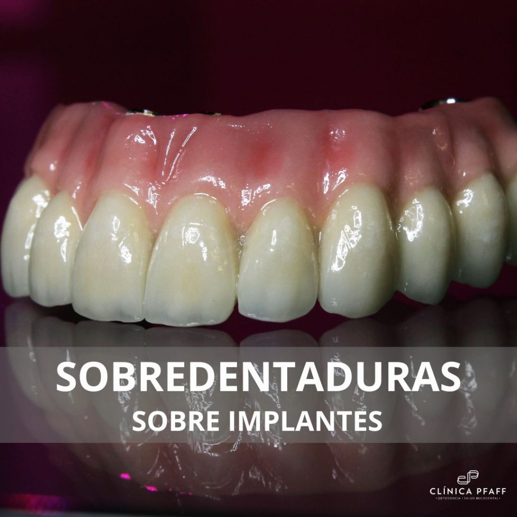 Sobredentaduras sobre implantes: comodidad y funcionalidad