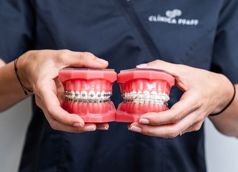 Tipos de brackets en Pfaff Barcelona Sarrià Sant Gervasi